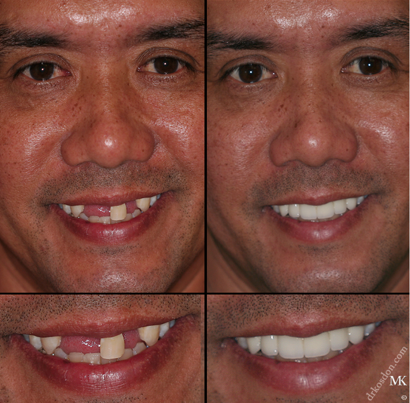 Зубы в 40 лет фото