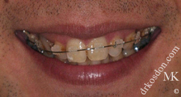 gum tissue excess smile before solution veneers