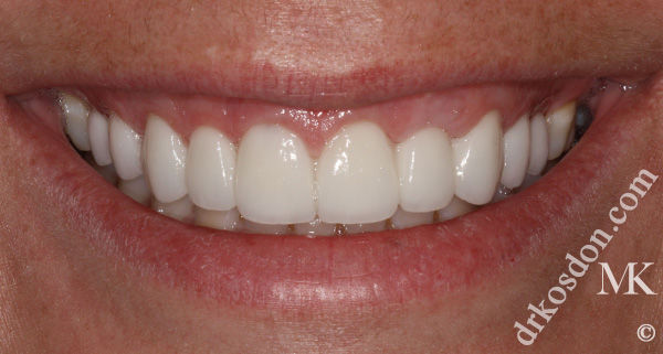 gum tissue excess solution before smile