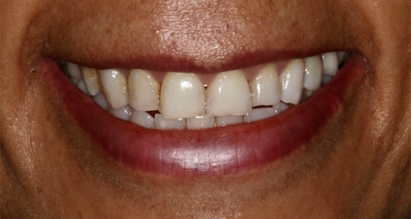 Porcelain Veneers Photos NYC - Smile Before Women Patient 100