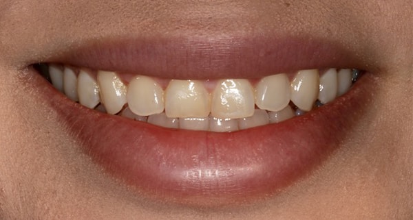 Porcelain Veneers Photos NYC - Smile Before Women Patient 107