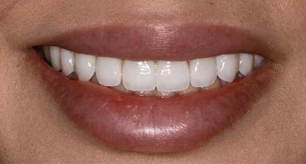 porcelain veneers after